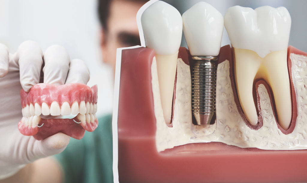 Имплантация зубов виды и методы