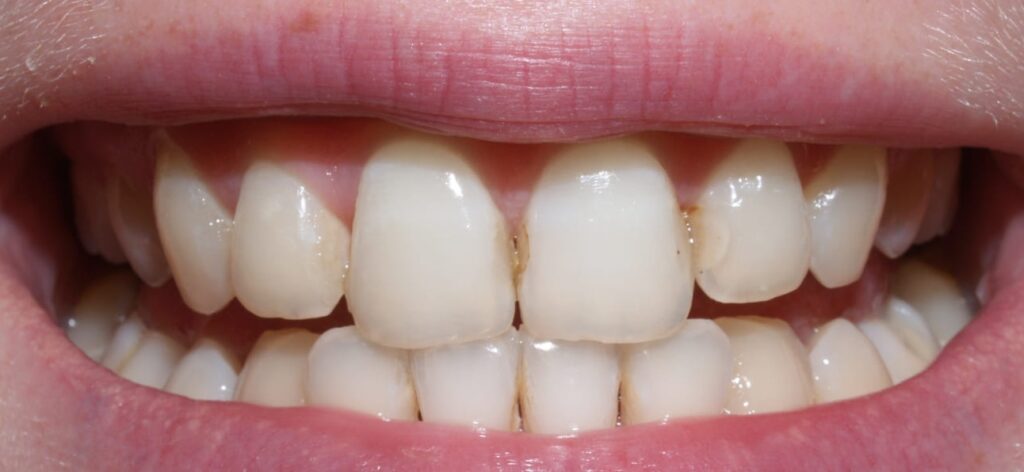 Белые пятна на зубах - почему они появляются?