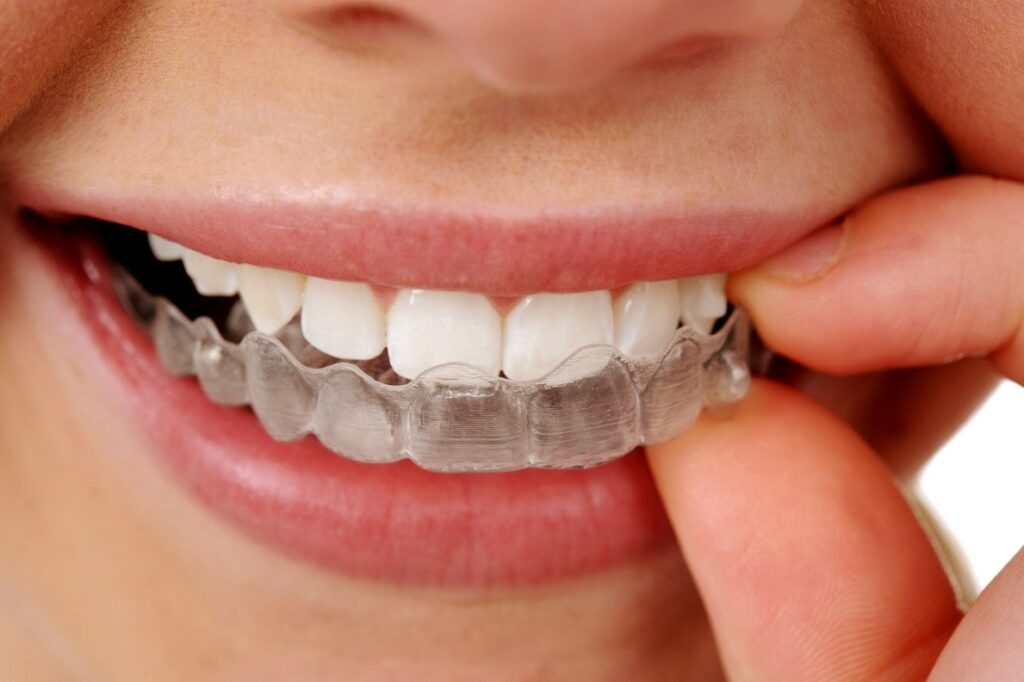 Как выровнять один зуб без брекетов?
