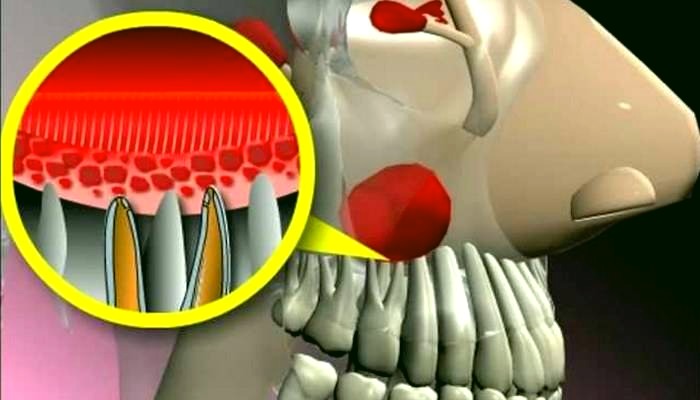 причины возникновения гайморита от болезни зубов